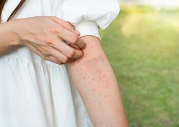 Understanding Dengue Fever: Causes, Symptoms, and Transmission